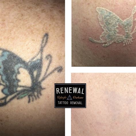 laser tattoo removal wilmington|dermatologist mayfaire wilmington nc.